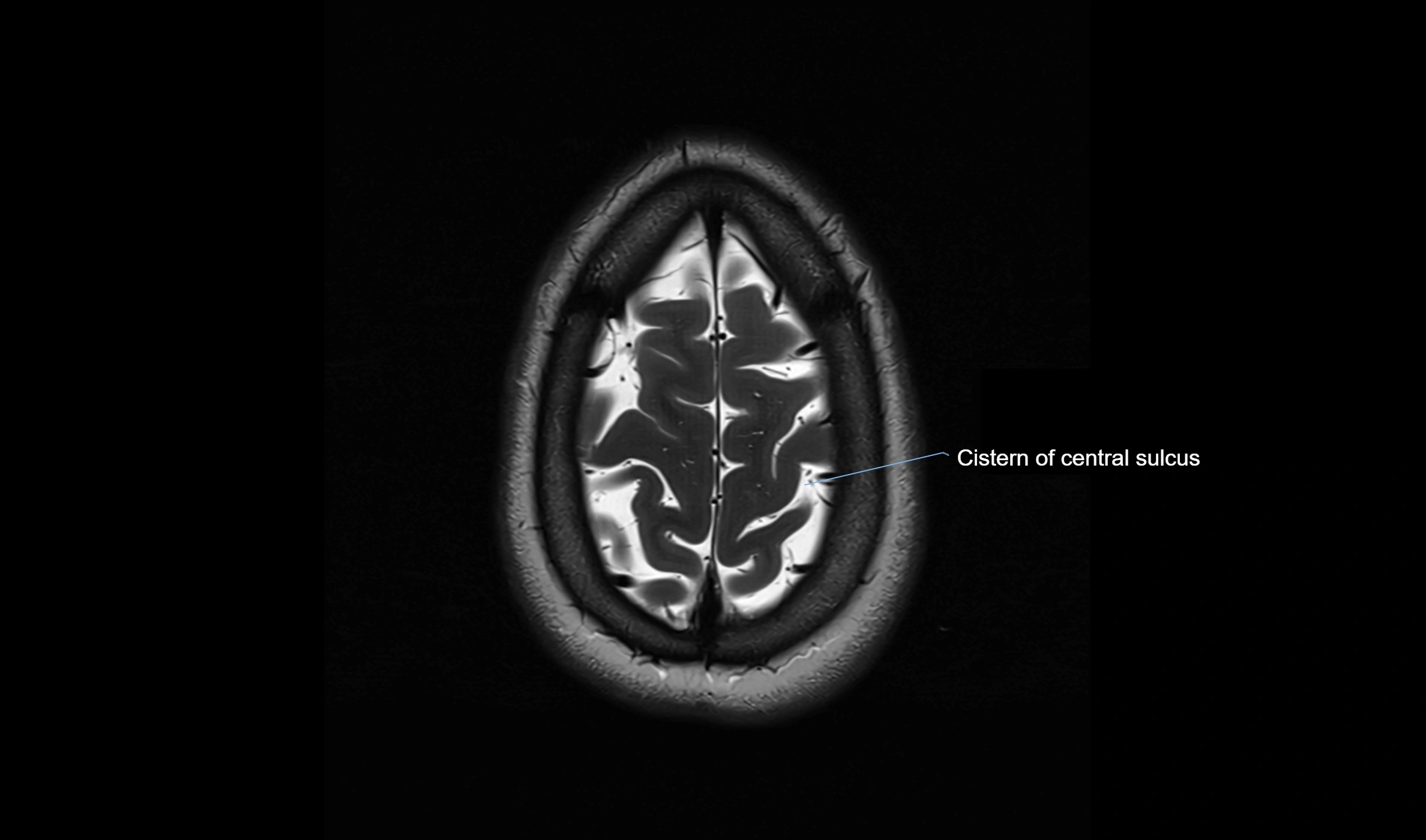 Brain cisterns  and ventricles  axial anatomy 3T MRI image-img-00001-00053.webp